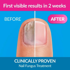 Excilor Nail Fungus Solution 30 ml