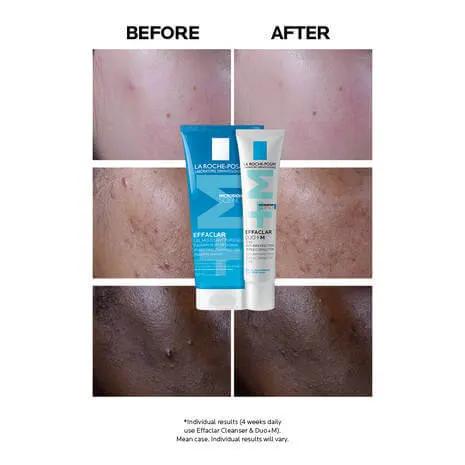 La Roche-Posay's Effaclar Duo+m: Anti-blemish Corrective Gel Moisturiser Acne-Prone,all skin tones,Anthelios Ultra Cream Xl Spf 50+ 50ml,Anthelios Ultra-light Invisible Fluid Tinted Spf50+ 50ml,Anthelios Uv Clear Sunscreen Spf 50,Anti-acne Starter Kit,Ant